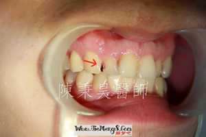 做梦梦到牙齿蛀了洞-神算网(做梦梦到牙齿蛀了一个洞)