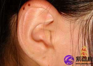 左耳轮廓上有痣代表什么(左耳轮廓有痣风水)