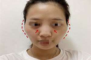 怎么才算颧骨高图片 颧骨高图片女和颧骨宽