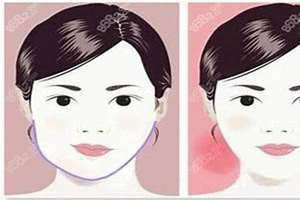 一边脸大一边脸小怎么纠正过来 一边脸大一边脸小怎么改善