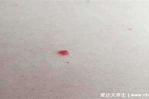 朱砂痣长在哪里有福气(朱砂痣长在哪里)