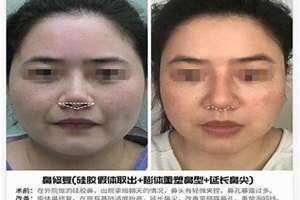 鼻孔外露的男人代表什么意思(鼻孔外露)