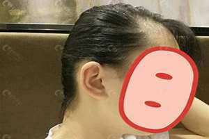 后脑勺扁平的适合什么发型 后脑勺扁平怎么恢复饱满