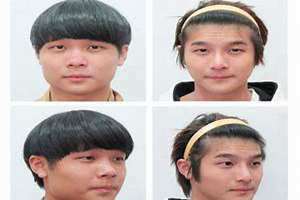 削下巴有什么后遗症(削下巴)