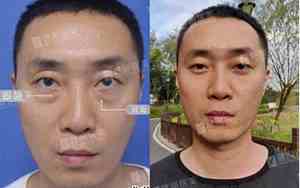 泪沟深的人命不好吗
