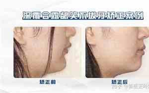 牙齿向前倾斜怎么矫正