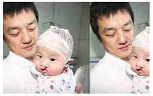 兔唇面相不利子嗣