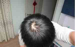 男人头顶突出有福吗