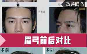 眉弓过低