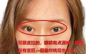 中年鼻头变大