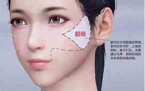 先天性苹果肌凹陷