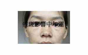 女人眼角旁有雀斑面相好不好