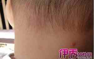 右腮帮有胎记面相好不好