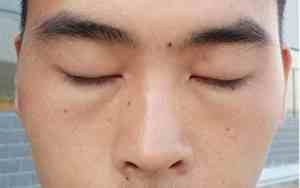 男人嘴巴长痘痘