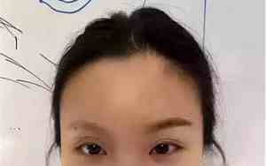 先天性无眉毛面相女