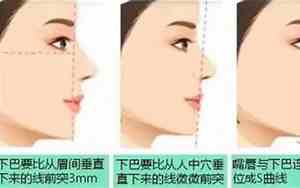 没下巴矫正