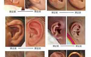 宝宝耳朵有折痕是什么迹象