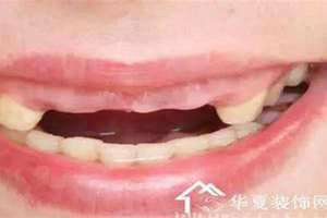 女人梦见自己掉了好多牙齿吐出一把 女人梦见自己掉了好多牙齿还流血