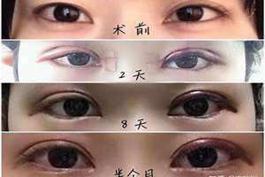 眼皮一只单一只双是什么原因 四个月宝宝眼皮一只单一只双