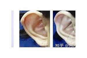 耳朵软的人有什么说法 耳朵软骨疼是什么原因