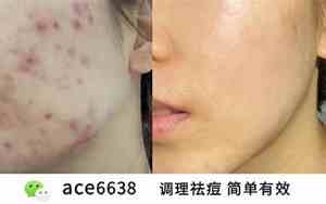 怎么改善脸凹陷