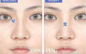 改善鼻翼宽度的方法